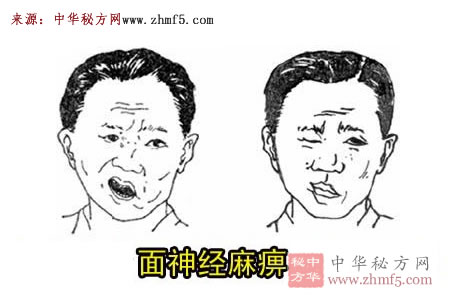 面神经麻痹