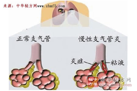 支气管炎