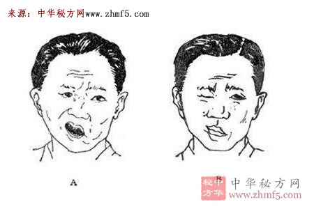 什么是面瘫 面瘫的原因、症状、诊断、治疗