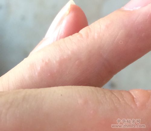 手指头好多隐形小水泡的原因及用什么药