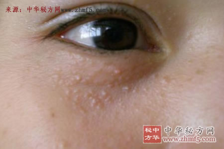 扁平疣